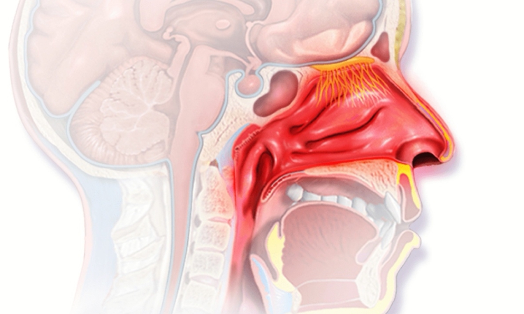 Алергичен ринит – често заболяване, което не бива да се подценява